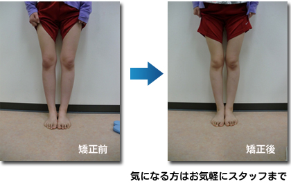 O脚矯正 長崎市の整骨院でo脚矯正をご希望の方は良整骨院へ