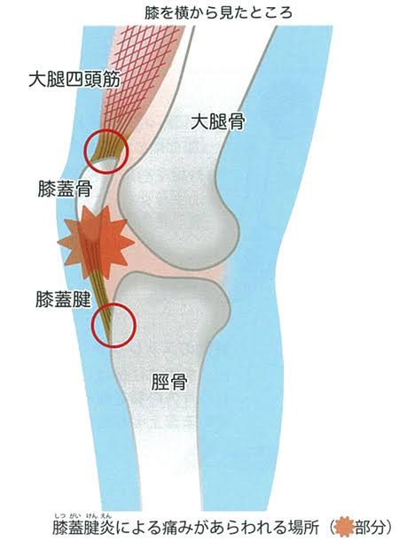 大腿四頭筋腱炎 膝蓋靭帯炎 ジャンパー膝 について 良整骨院
